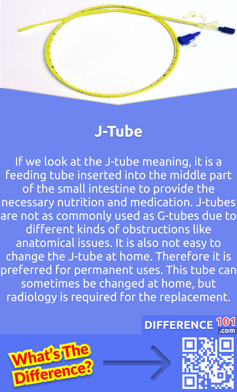 What Is J-Tube? If we look at the J-tube meaning, it is a feeding tube inserted into the middle part of the small intestine to provide the necessary nutrition and medication. J-tubes are not as commonly used as G-tubes due to different kinds of obstructions like anatomical issues. It is also not easy to change the J-tube at home. Therefore it is preferred for permanent uses. This tube can sometimes be changed at home, but radiology is required for the replacement. There are various methods through which a J-tube can be inserted into the small intestine. Some common procedures include open surgery, gastric bypass, and percutaneous endoscopic jejunostomy. J-tubes are used for patients with chronic vomiting, high risk of respiration, and low gastric motility. J-tubes are also inserted in patients where G-tubes can not work. But a J-tube can cause more problems than a G-tube, like irritation and granulation of tissues.
